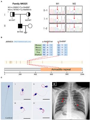 Case Report: Novel Biallelic Mutations in ARMC4 Cause Primary Ciliary Dyskinesia and Male Infertility in a Chinese Family